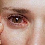 Remedies To Prevent Dry Eyes Fb.jpg
