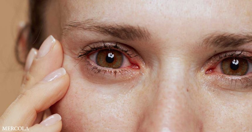 Remedies To Prevent Dry Eyes Fb.jpg