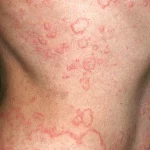 1800x1200 What Is Chronic Spontaneous Urticaria Or Csu Features.jpg